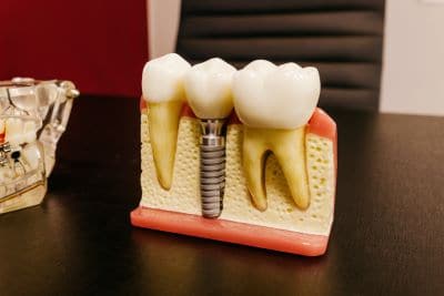 Dental Implants Tulsa